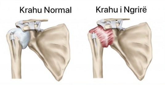 krahu-normal-vs-krahu-i-ngrire